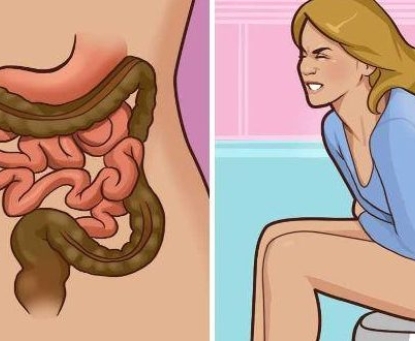 Dấu hiệu phổ biến của ung thư trực tràng 